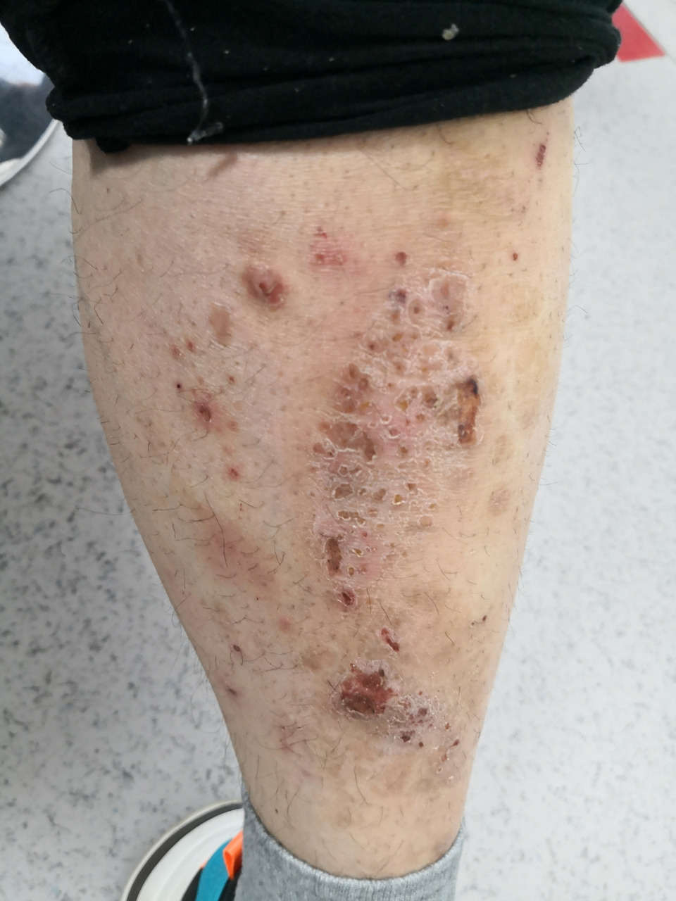 银屑病患者并发瘢痕疙瘩,小腿抓痕血痂症状#银屑病##瘢痕疙瘩