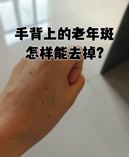 女人手背上长斑是什么原因为什么在线