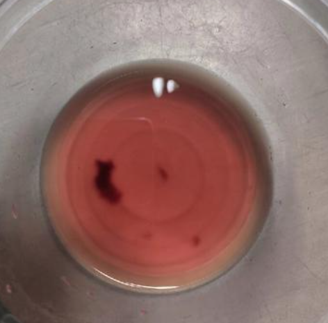 男性尿血还有血块可能是这些原因引起的: