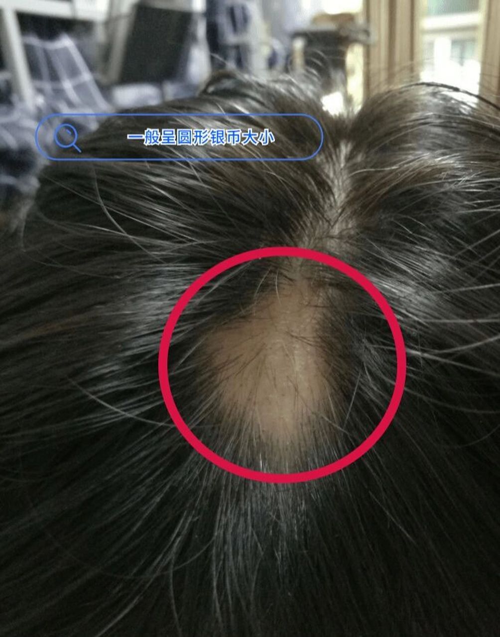 能不能自愈0303 01斑秃是所有脱发症状中最让人烦恼的一种.