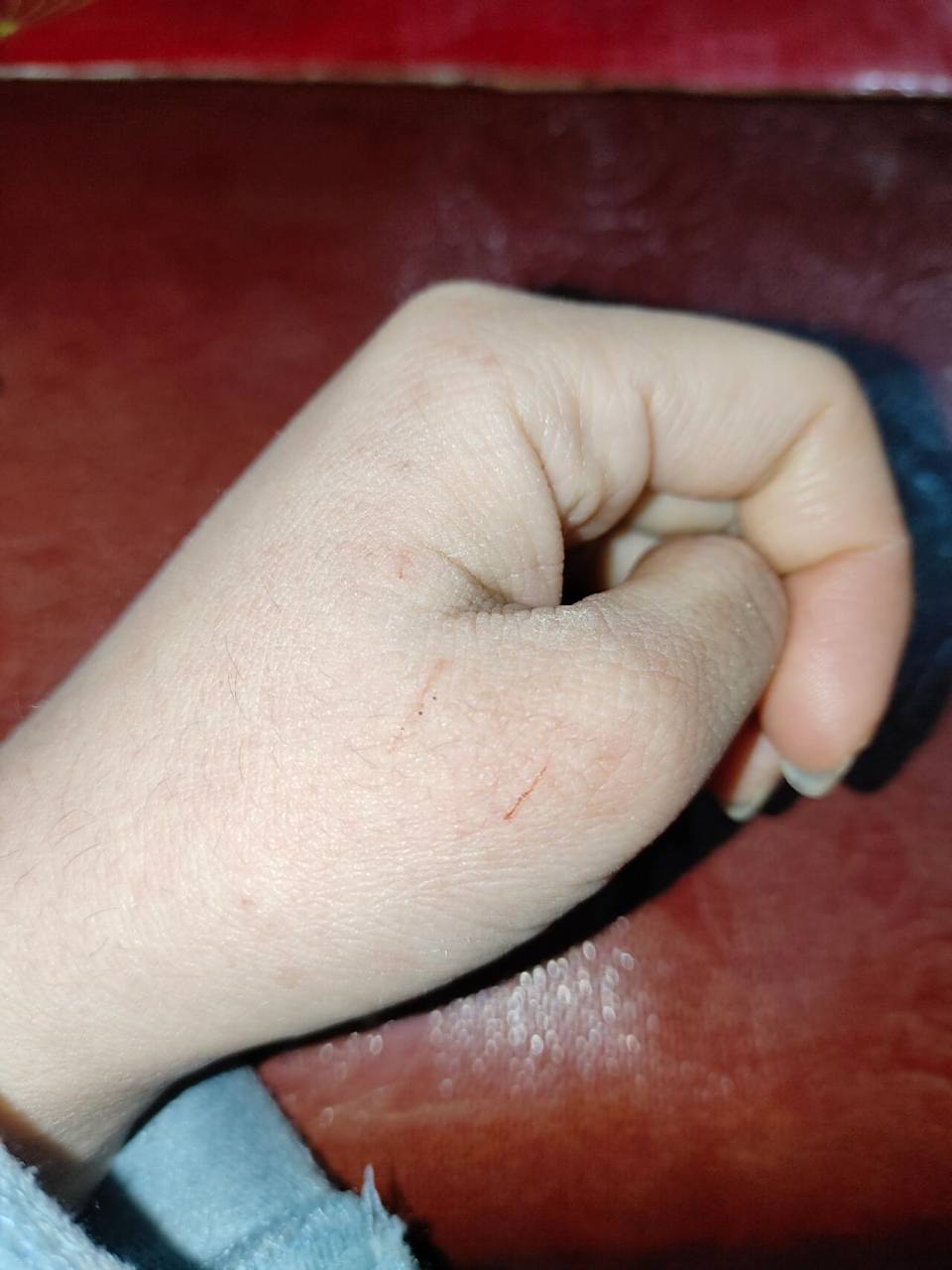 姐妹们 被猫抓伤了不打疫苗会怎样?