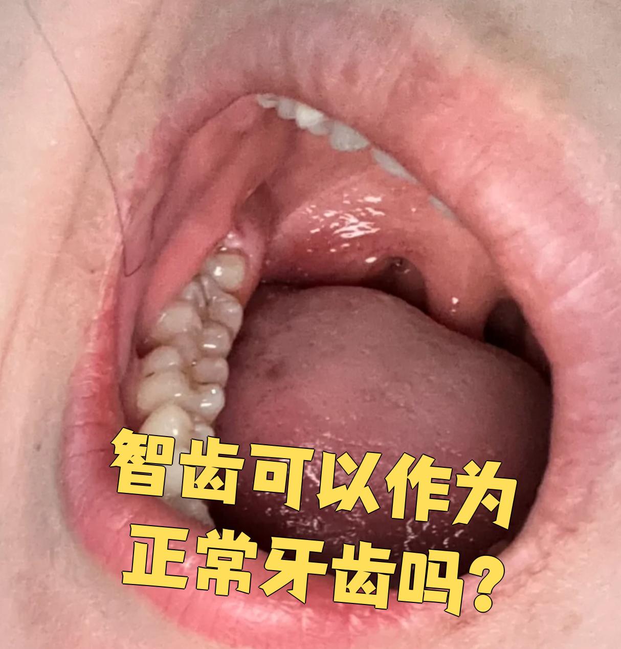 智齿有时候可以当正常牙用