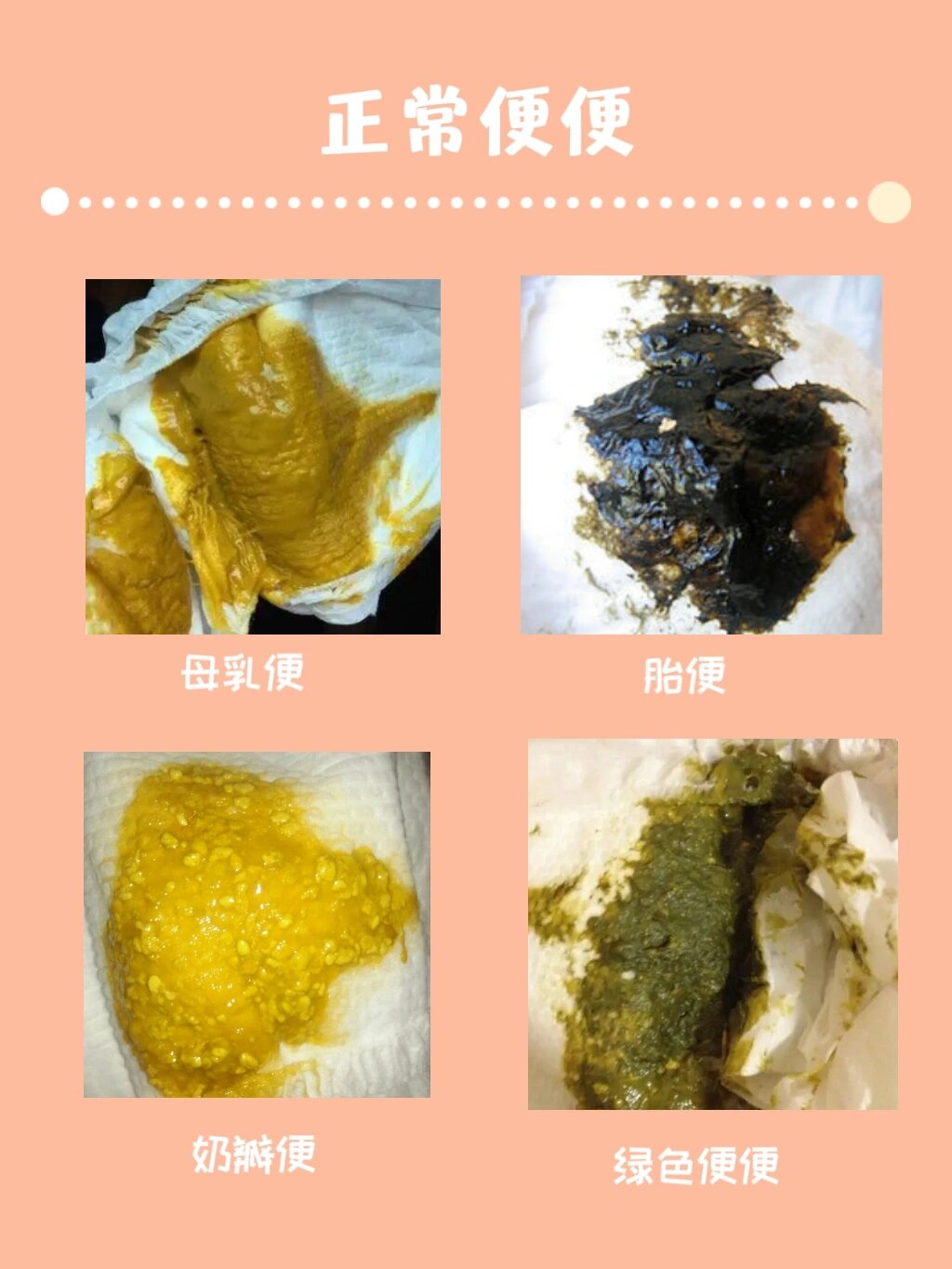 建议收藏丨正常和不正常的宝宝大便都在这了 上篇写了宝宝腹泻问题