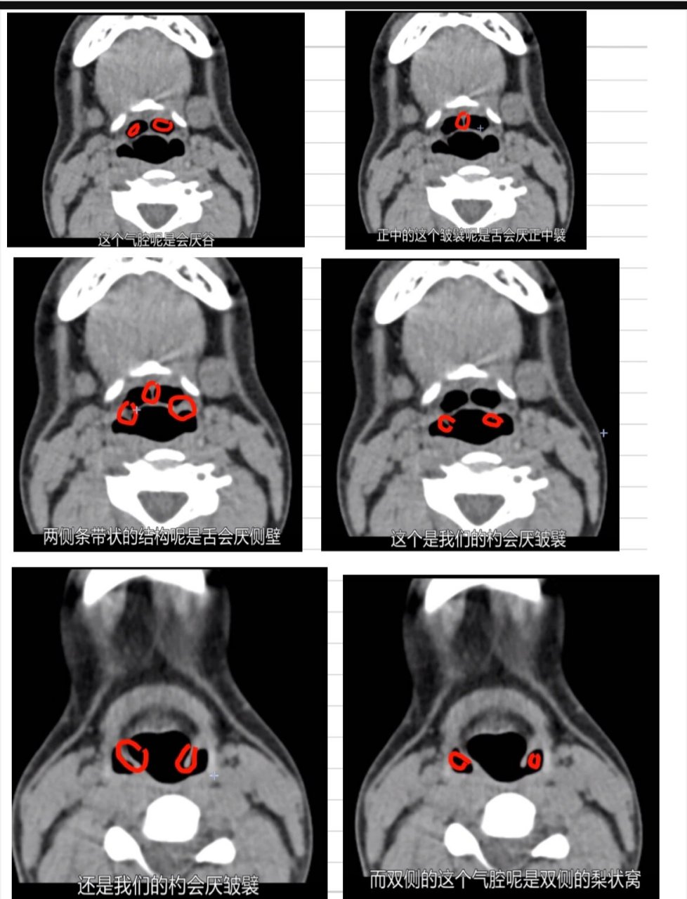 会厌解剖结构CT图片图片
