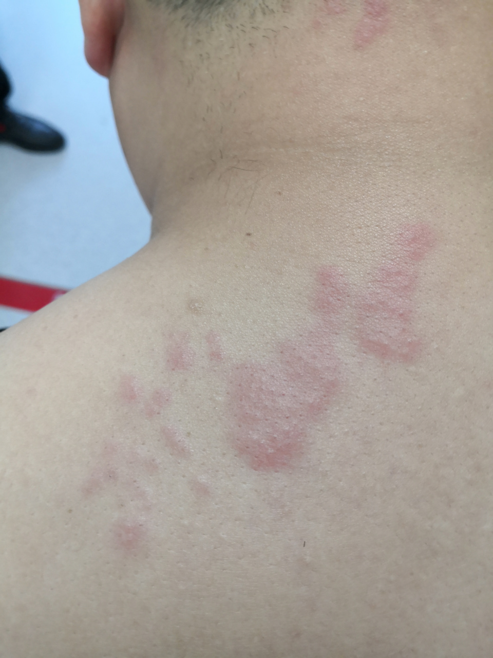 头颈部和一侧肩部的红斑水疱症状,疼痛轻微.考虑带状疱疹早期症状.