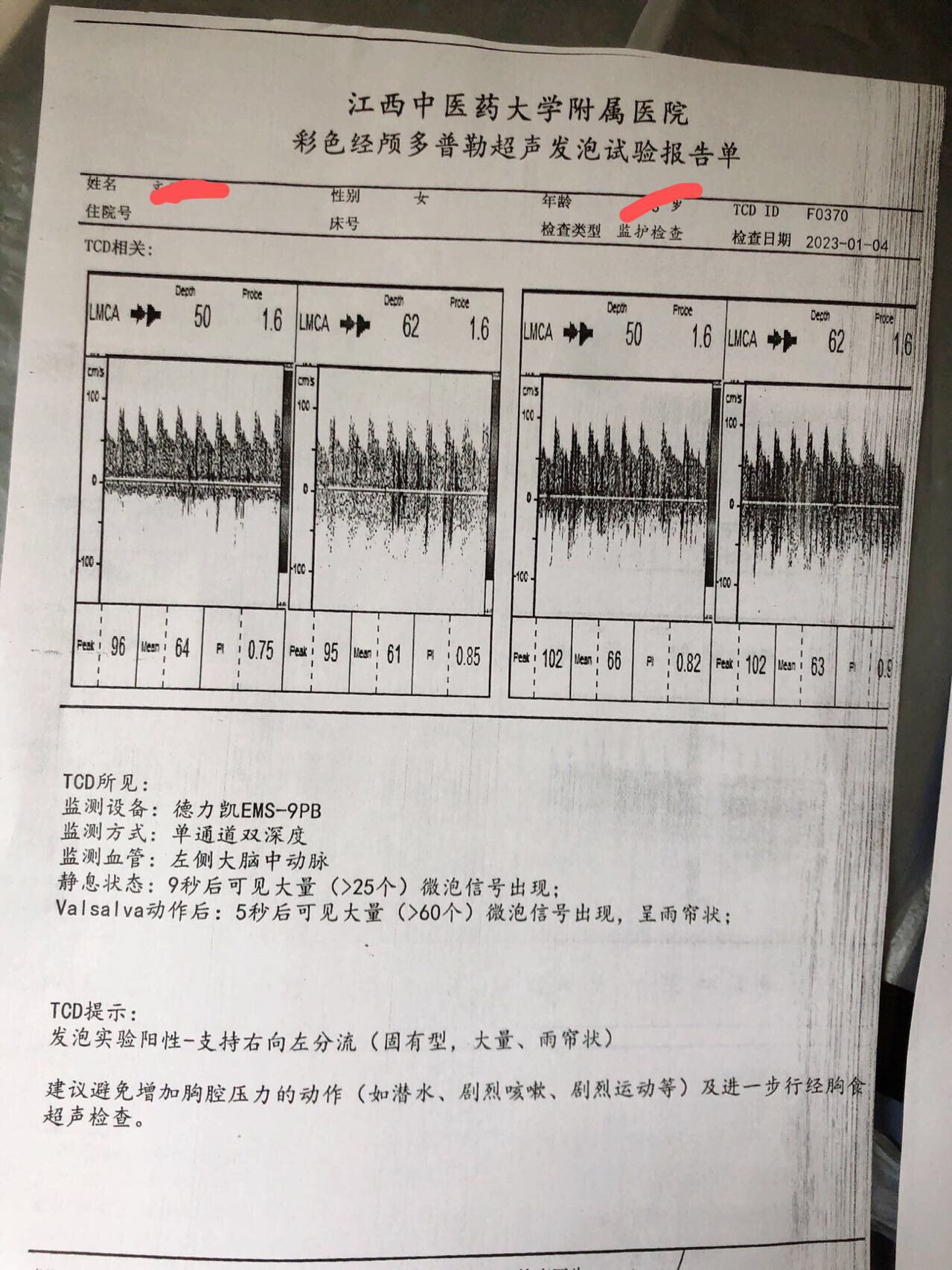 卵圆孔未闭