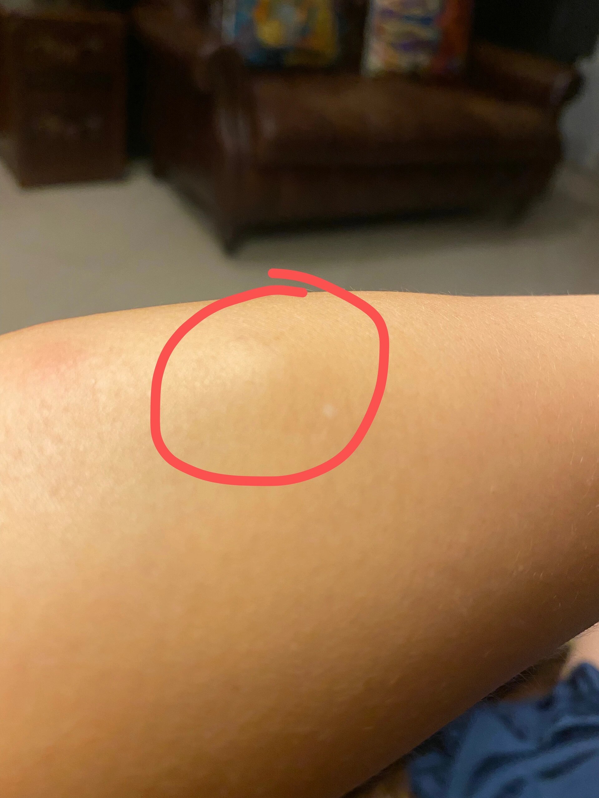 手臂胳膊皮下长个硬疙瘩