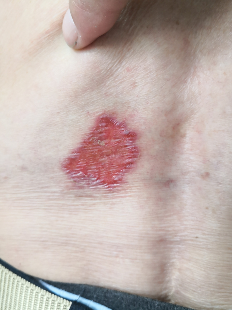 汗孔角化症##解决皮肤问题专注皮肤美容