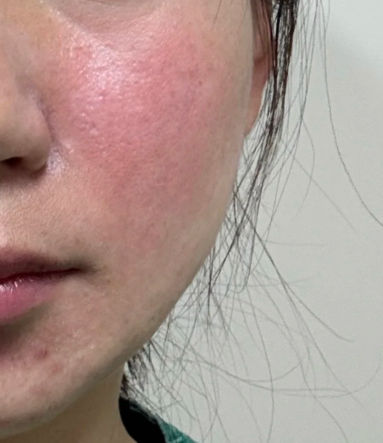 风吹后脸部出现痛,痒,发红,可以这样处理: