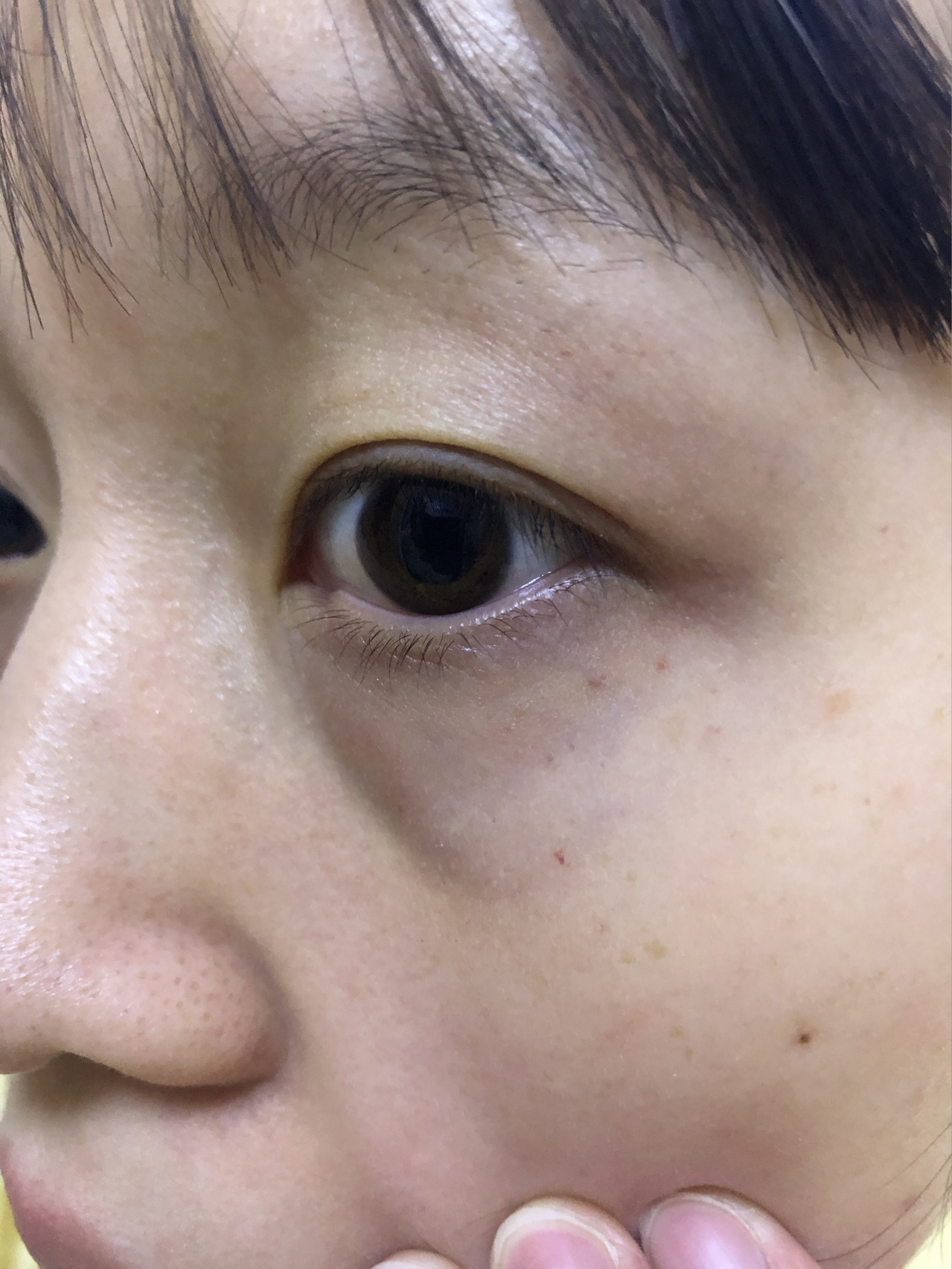 眼下长红点 有谁知道这个是什么吗?