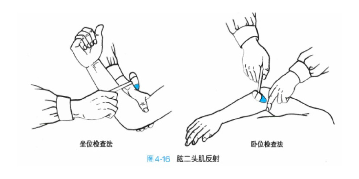神经内科——反射检查(一