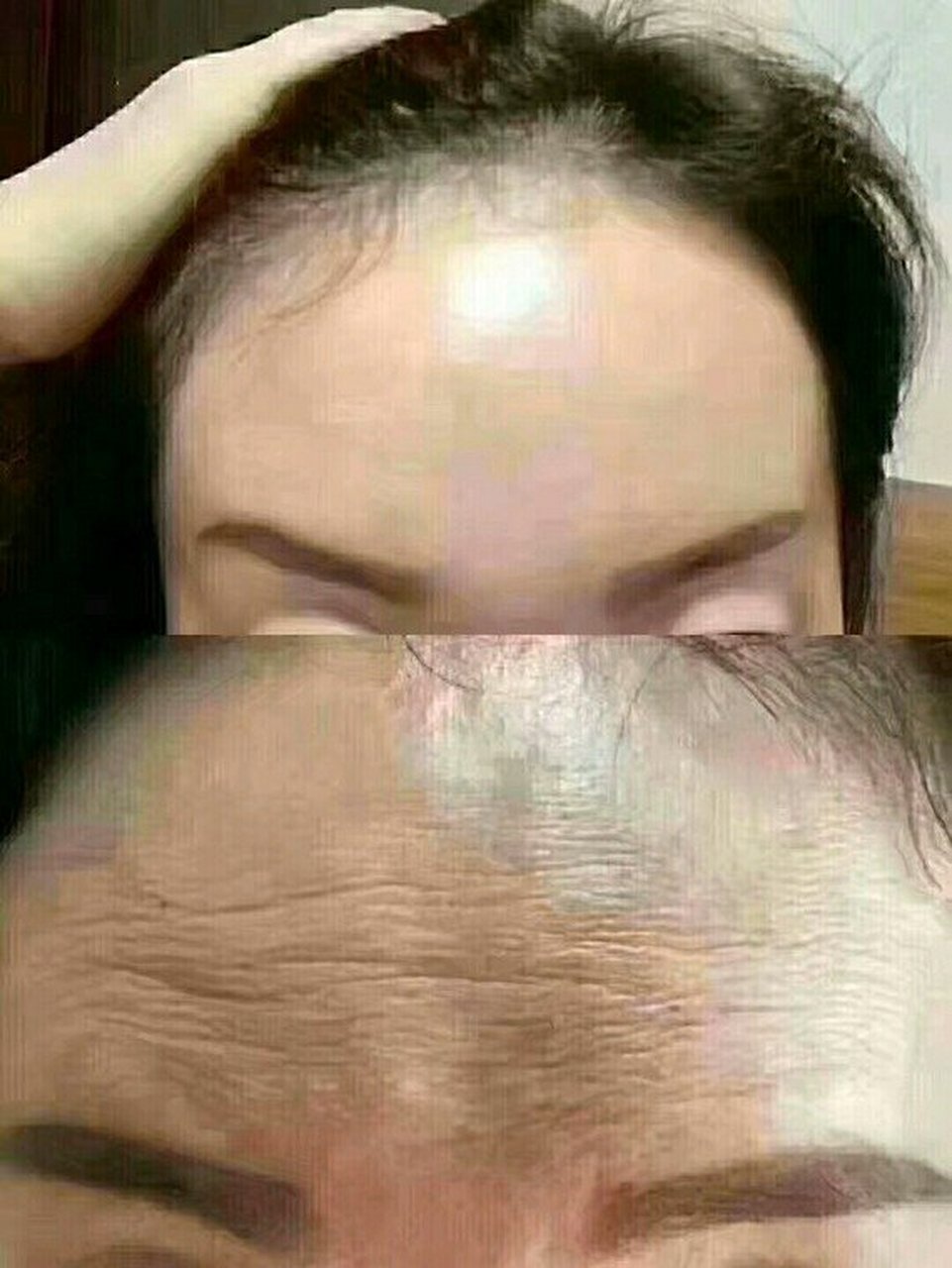 都忘记来分享一下打了除皱针的感受了～ 肉毒素去抬头纹术后第15天