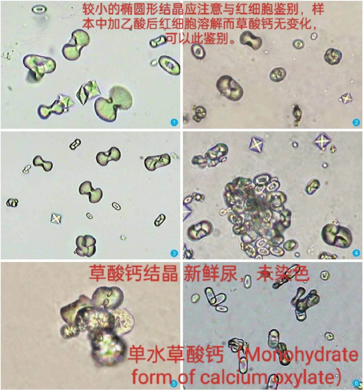 尿结晶图谱大全图片