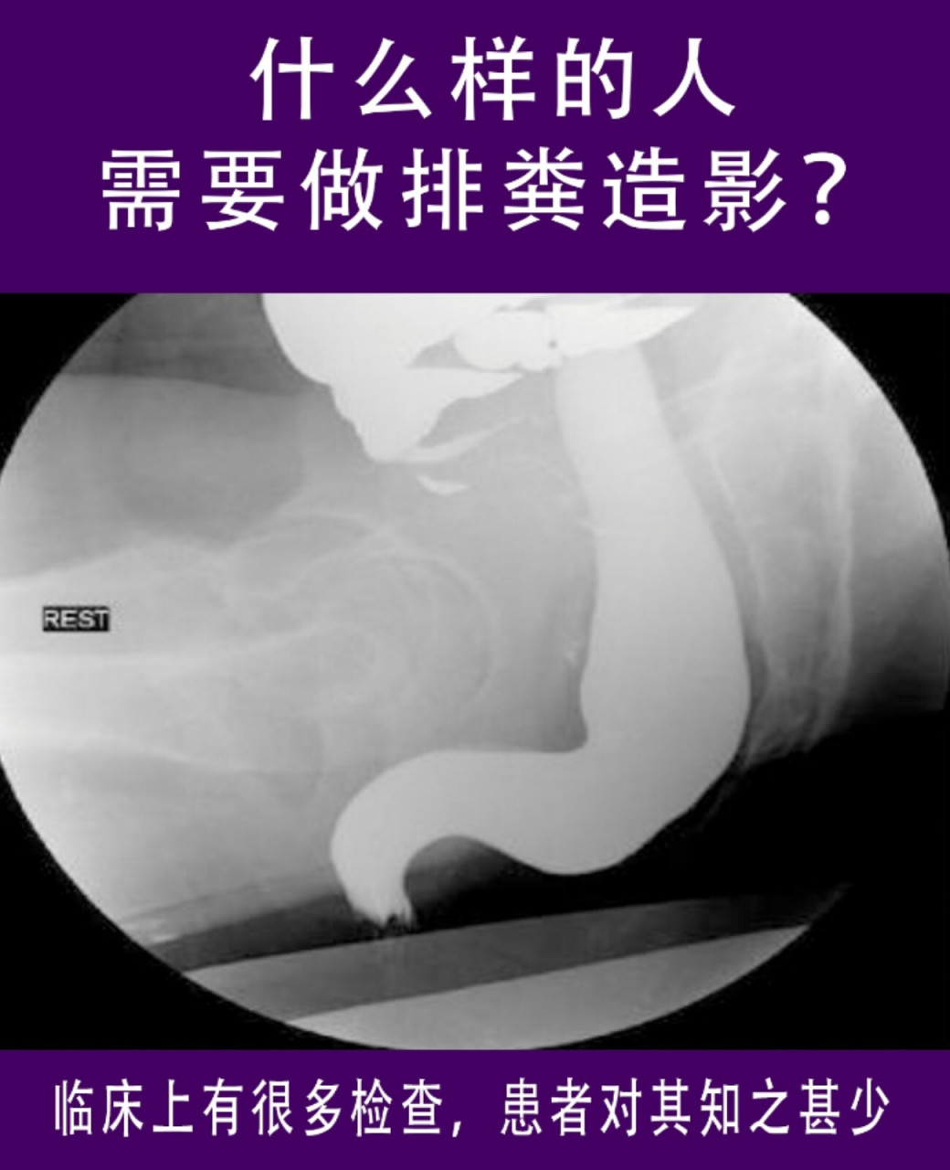 便秘后为什么医生会建议去做排粪造影, 以及什么人适合做排粪造影?