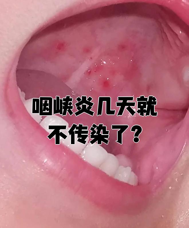  嗓子发炎是什么菌感染(嗓子发炎是什么菌感染引起的)