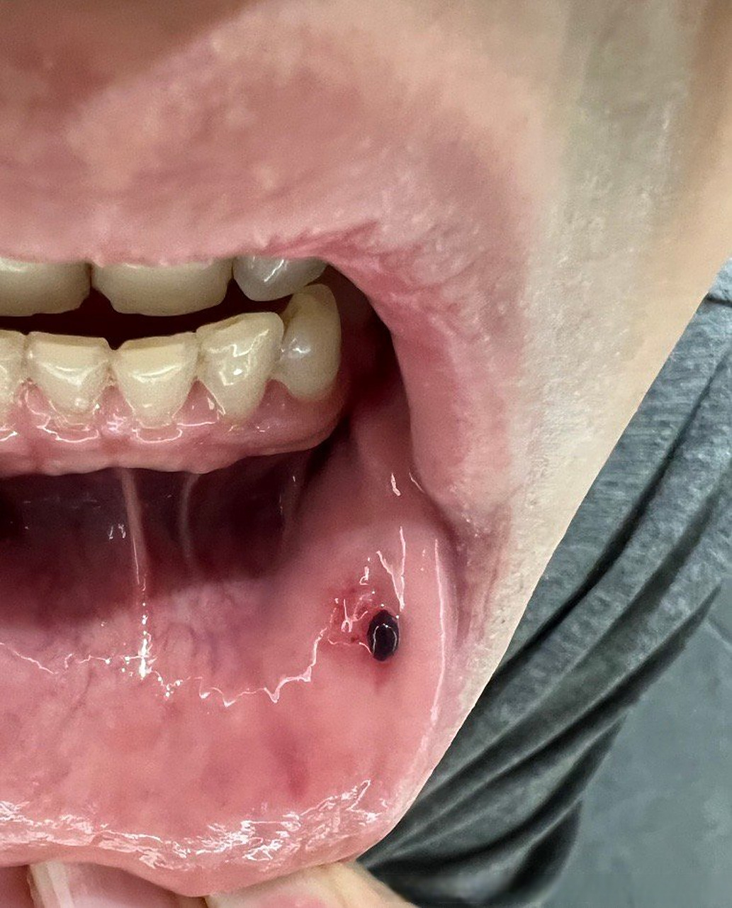 这种血泡大部分都可以吸收.