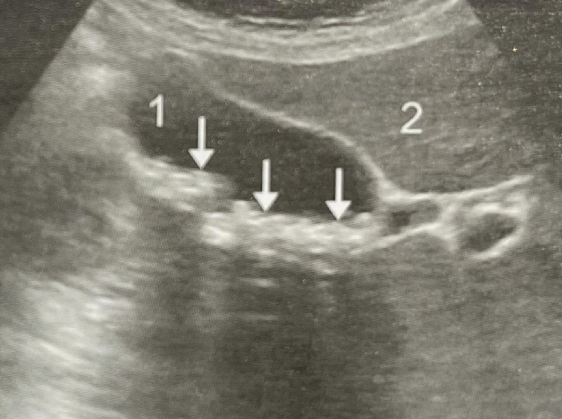 b超下泥沙样胆囊结石影像