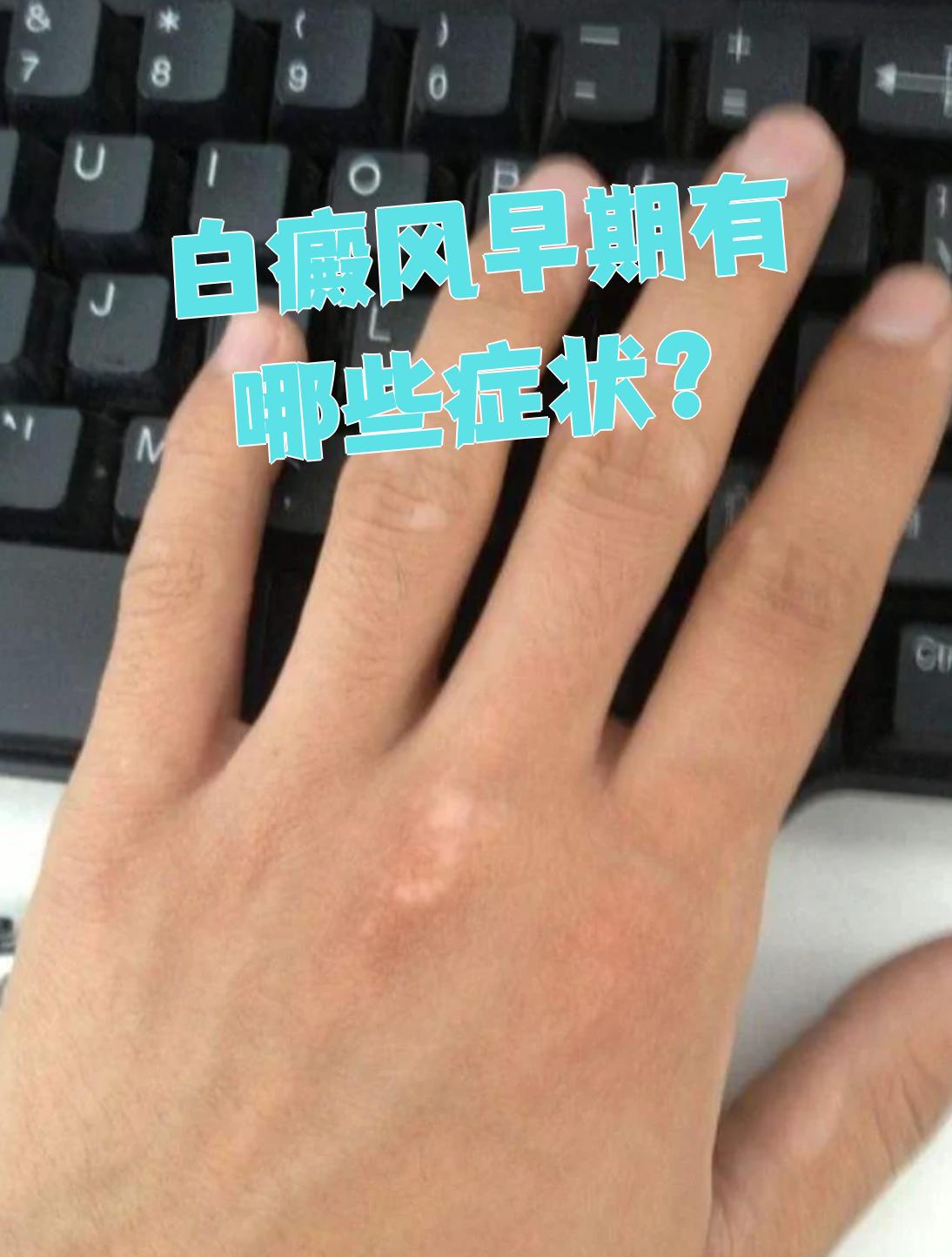 白癜风早期有哪些症状?
