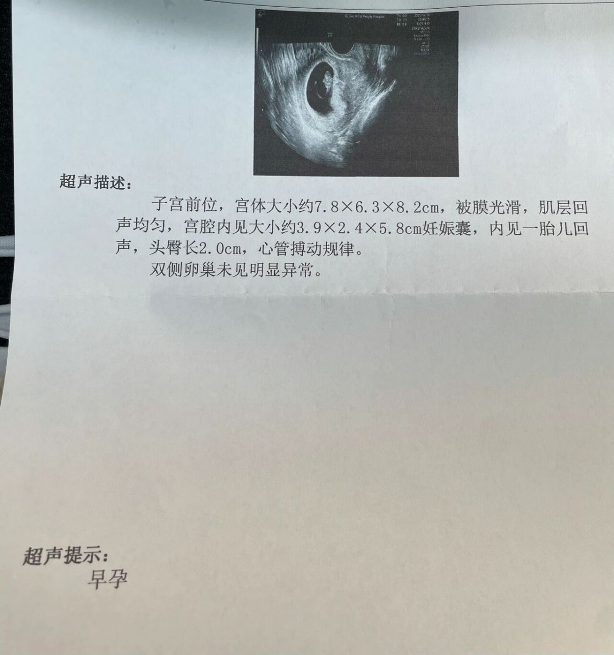 孕9周,真正的胎儿了 十天前胎芽8mm,孕囊也偏大,今天复查感觉宝宝很