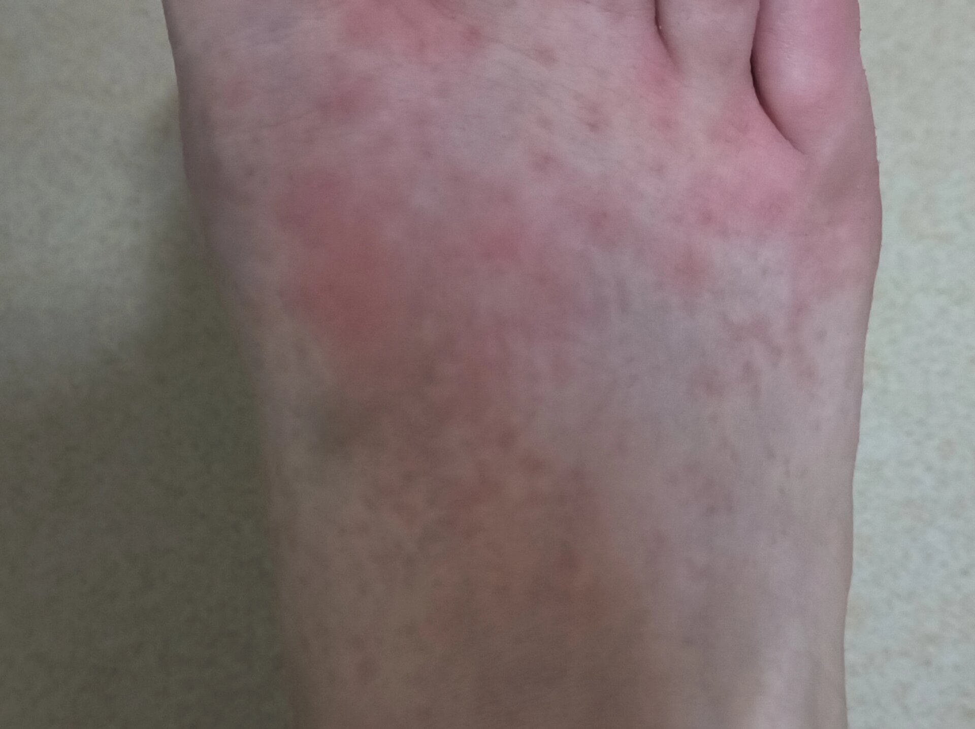 脚上突然长了好多红色疹子,有网友说是过敏性紫癜,因为之前得过这个病