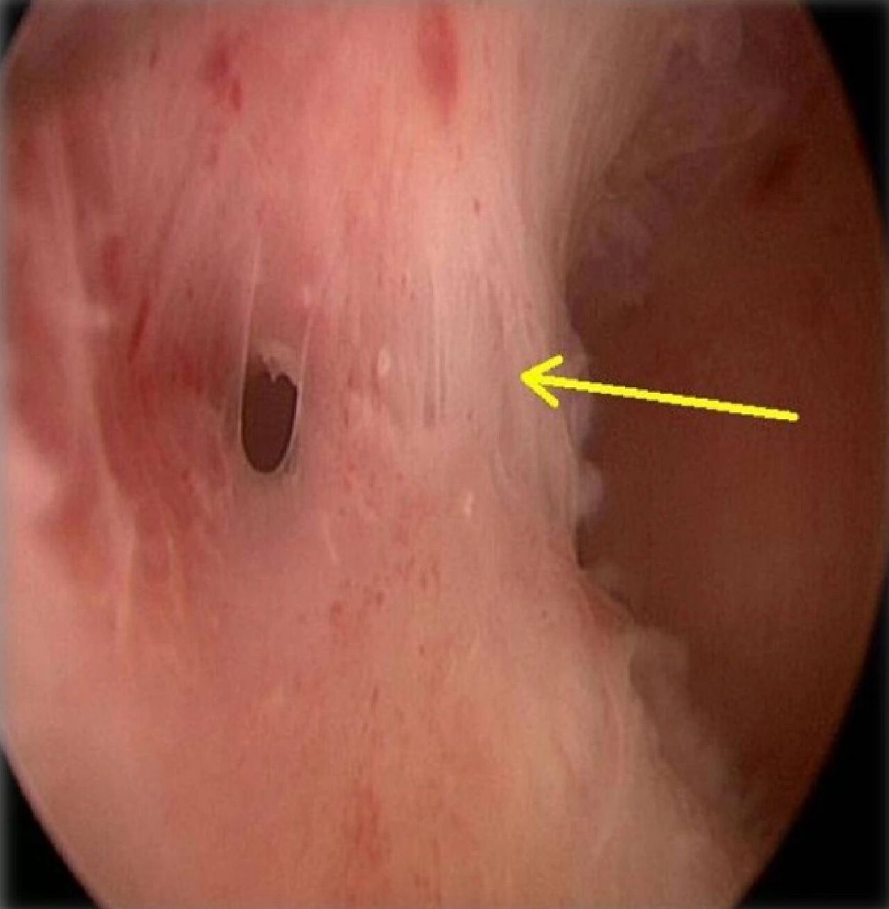 90%的宫腔粘连是由于怀孕后子宫损伤造成的,其中绝大多数是人工流产