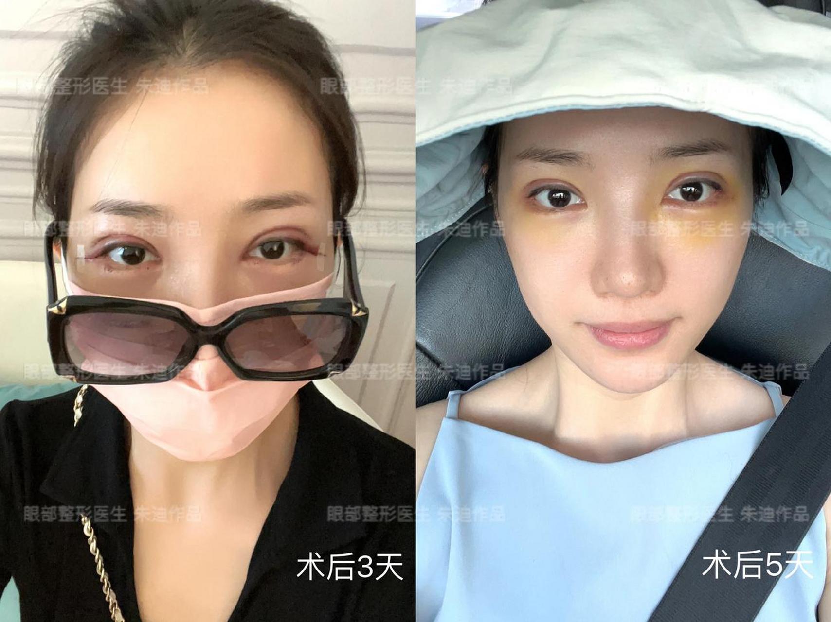 不妨试试【adm人工真皮卧蚕】,只需20分钟,甜美的卧蚕就有了!