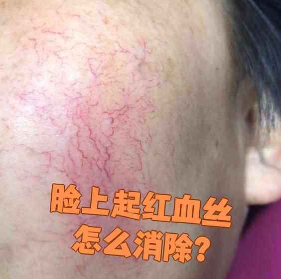 脸为什么有红血丝