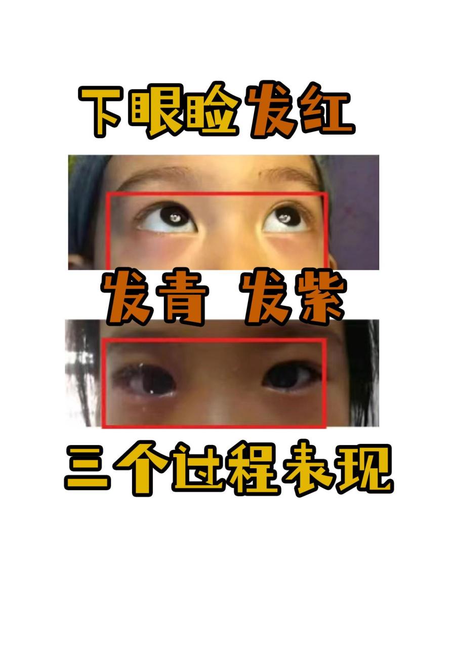 孩子下眼睑发红发青发紫怎么办?