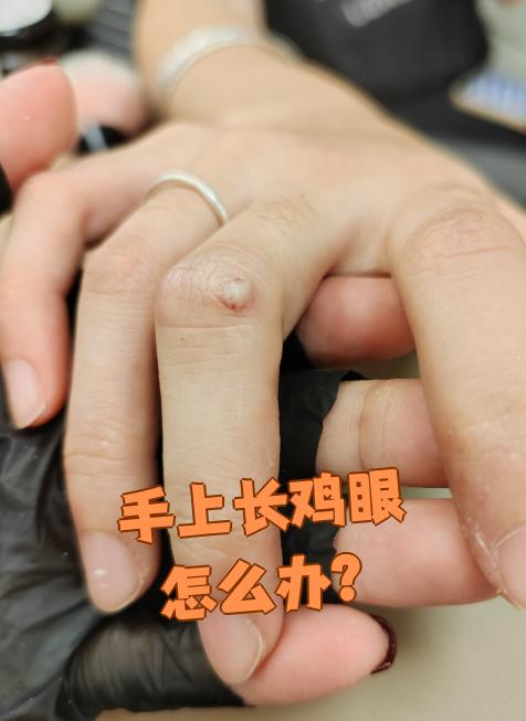 主要是因为局部皮肤长期被摩擦或挤压