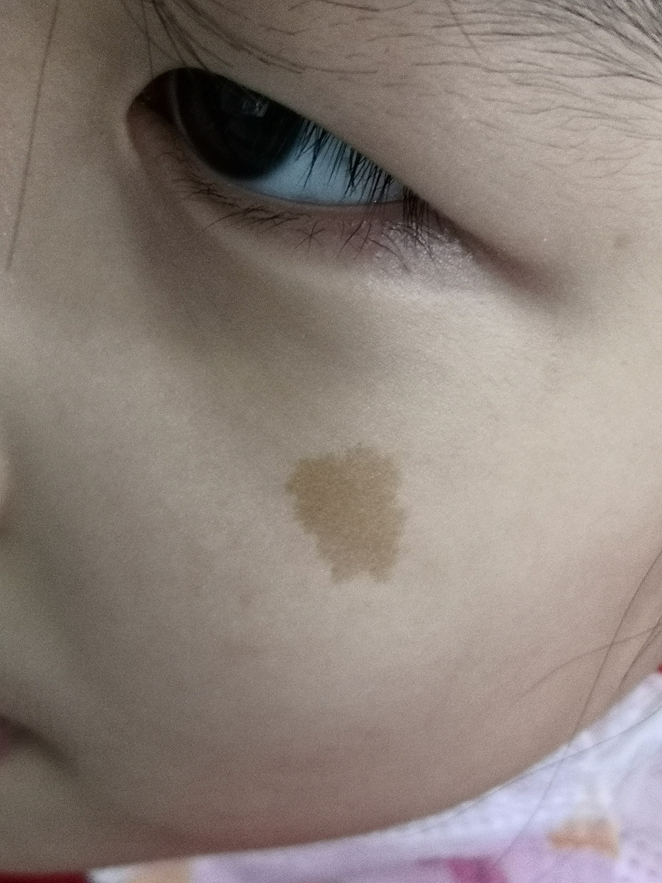 面部咖啡斑症状.可以手术切除治疗.美容效果不错的#美容##皮肤外科