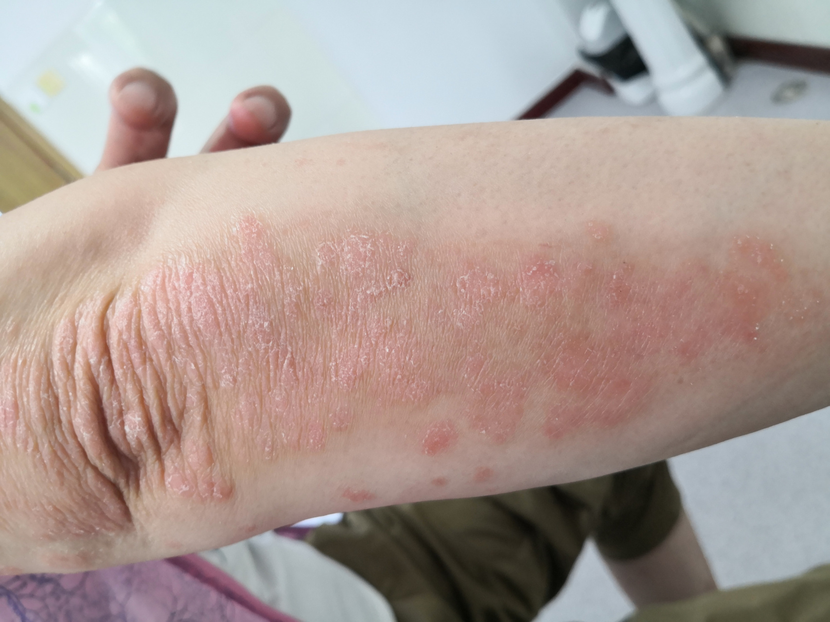 解决皮肤问题专注皮肤美容##银屑病