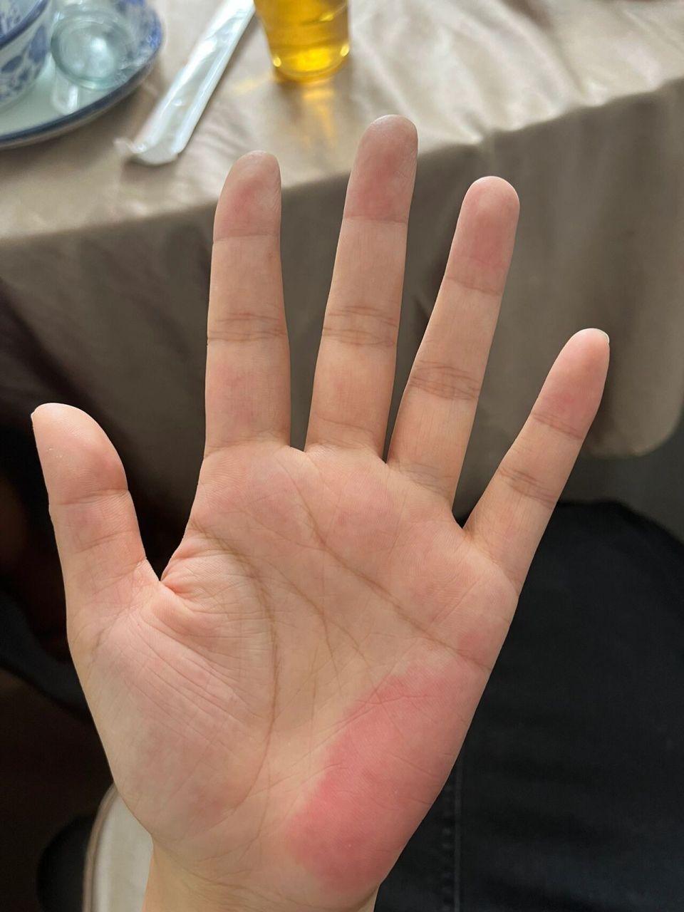 小鱼际发红? 小鱼际发红是怎么回事啊