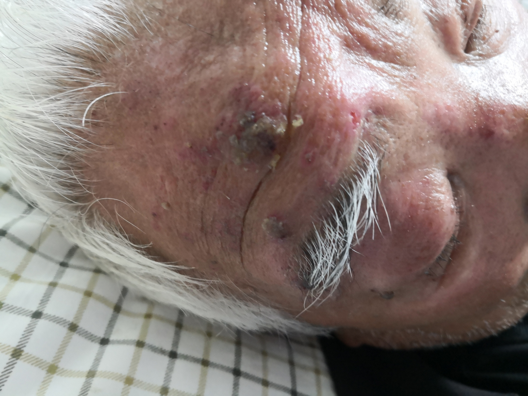 老年男性患者的头皮额头部位的带状疱疹症状.