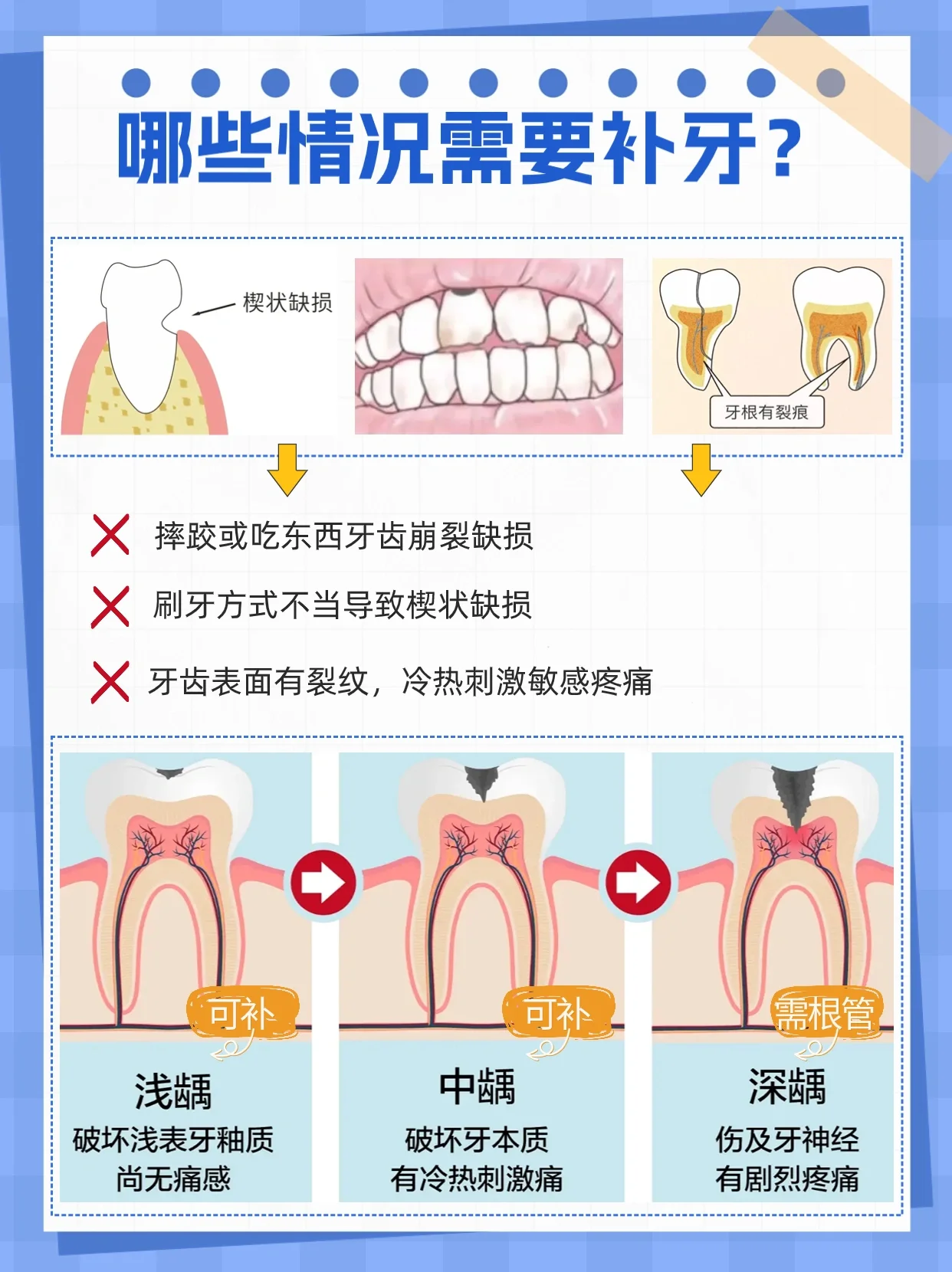 补牙别再被忽悠了!牙医告诉你怎么选材料!