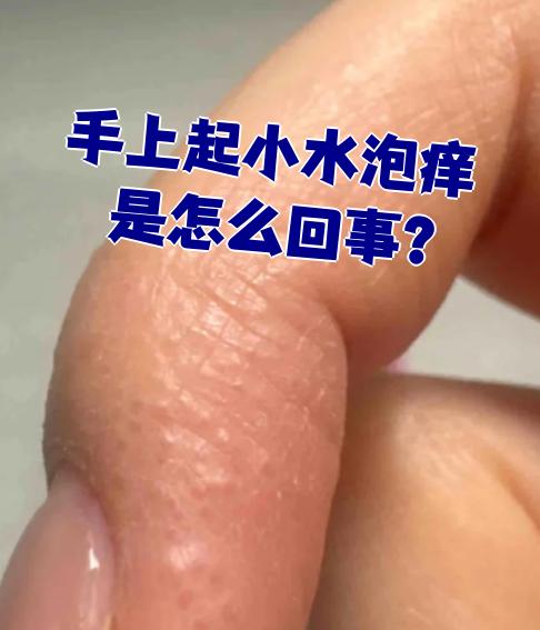 手上为什么会起小水泡不痛不痒为什么在线 手上为什么会起小水泡不痛不痒为什么在线