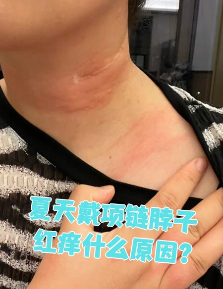 夏天戴项链脖子红痒,最常见的原因是过敏,湿疹或荨麻疹
