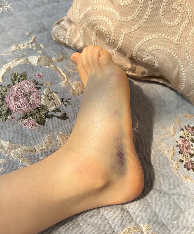 脚扭伤后一开始不痛但越来越痛,这其实和踝关节损伤的类型有关