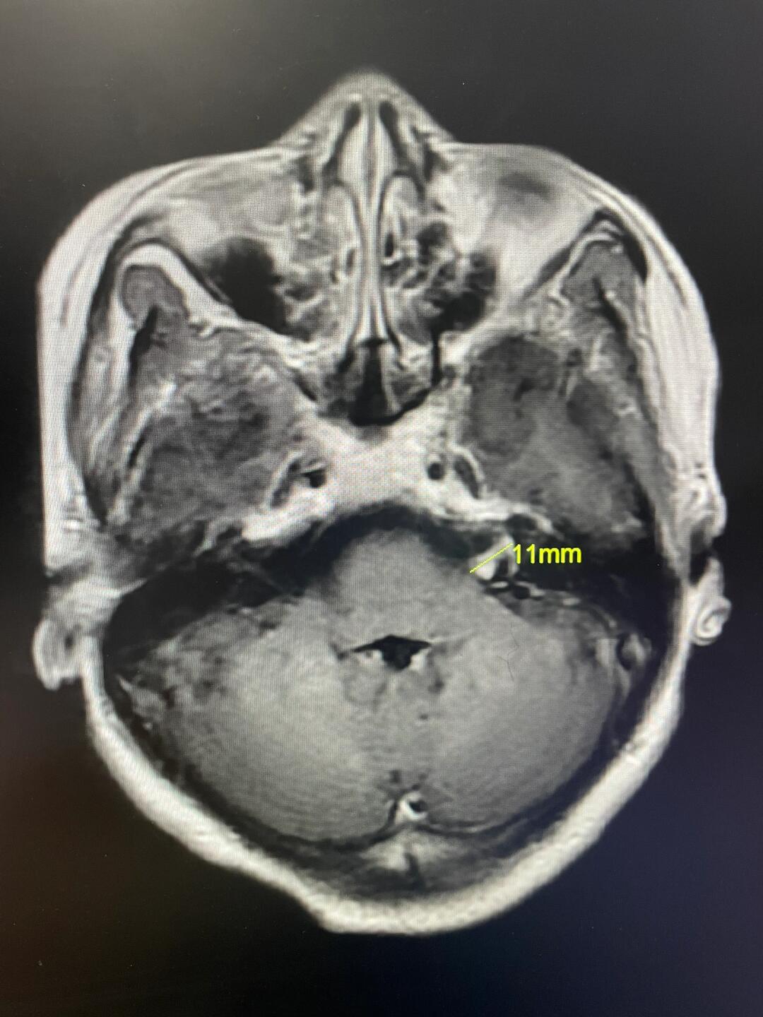 小型听神经瘤要不要手术