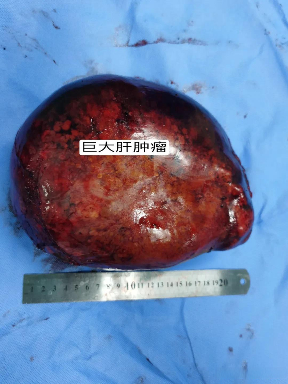 这种肿瘤直径20cm,在体内生长时间接近一年
