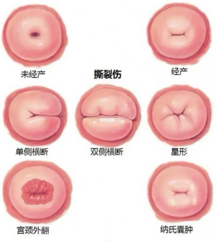 正常的子宫口是什么样子的人流过宫颈口图片流产宫颈口会开吗堕胎的