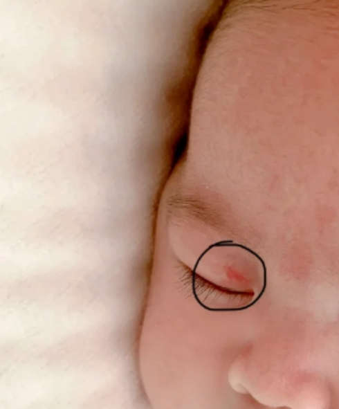 新生儿眼皮上出现一小块红色,常见原因包括皮肤损伤,血管痣或血管 