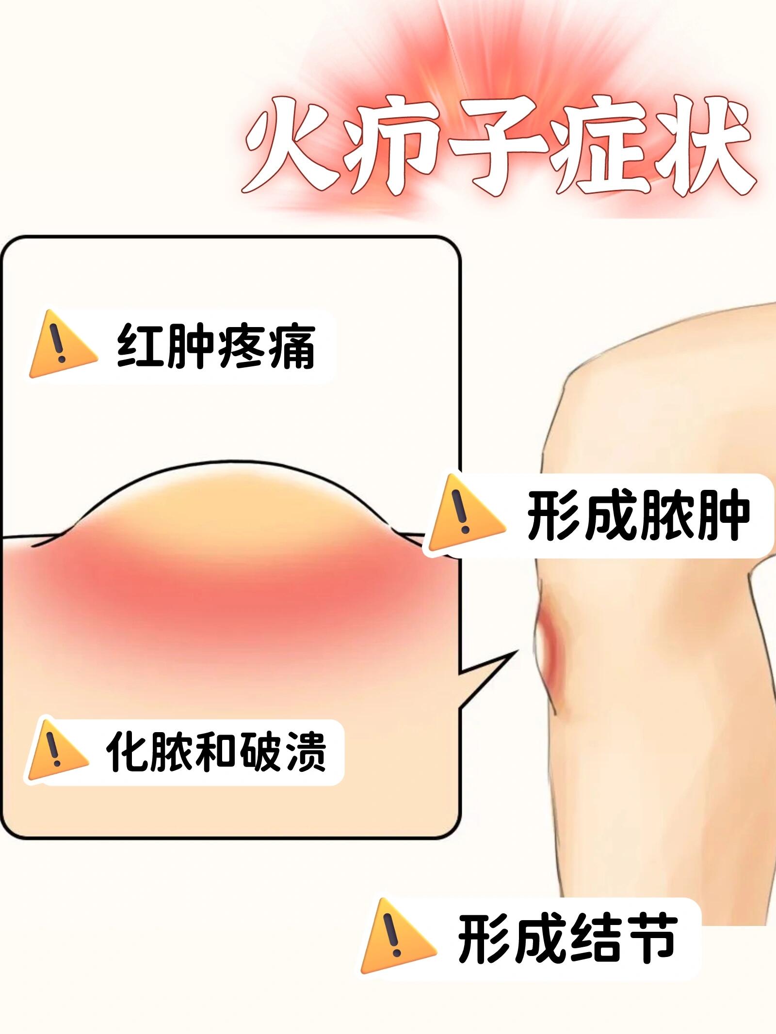 怎么判断是不是疖子图片