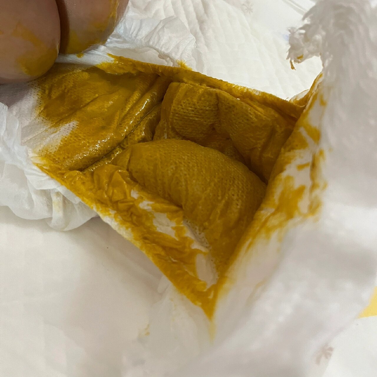 宝宝拉便便稀泡沫便 宝宝三个半月了,一直拉这种便便,2-3天拉一次,放