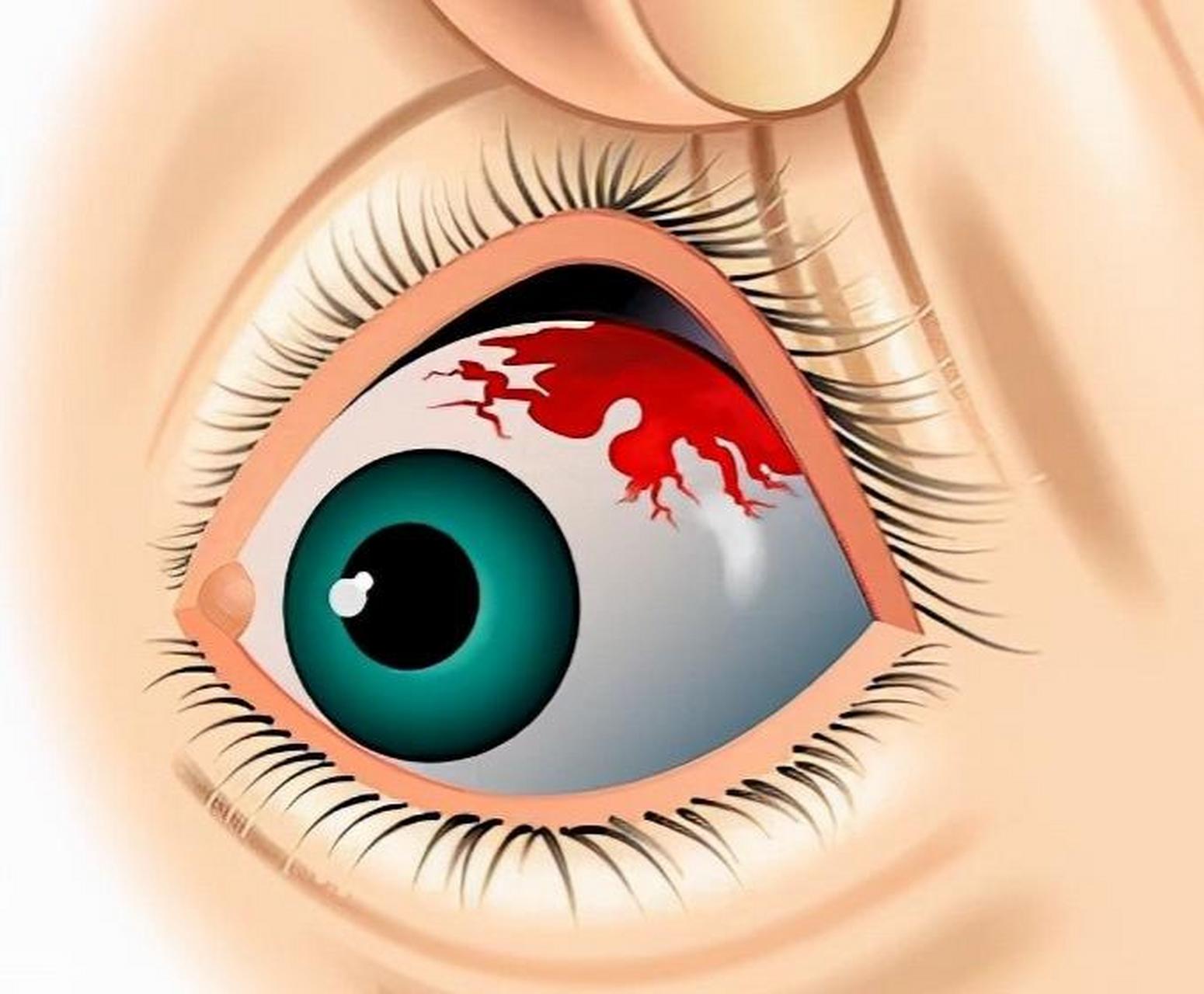 眼底出血 视力突然下降 3个解决方法教给你 02  视力突然下降,视物
