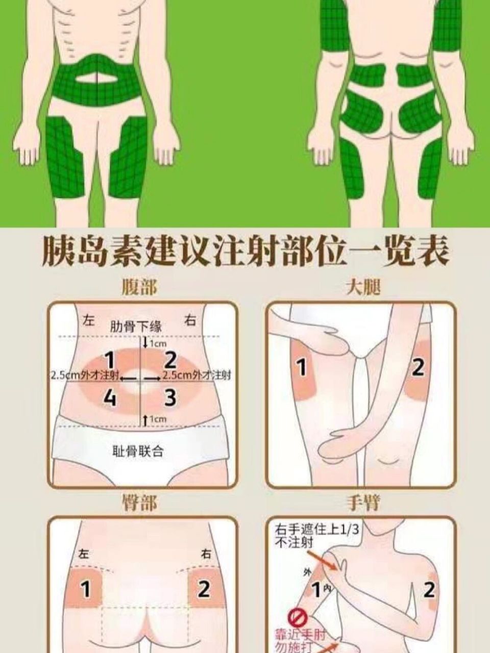 胰岛素注射部位图示 糖友们切记不能频繁扎同个地方 一定要交替轮换