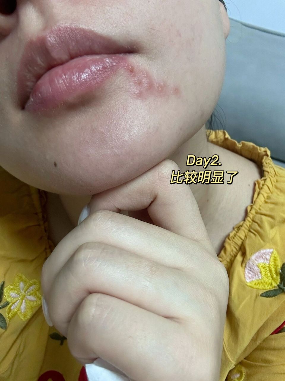 孕19w |口周发了疱疹怎么办02 要说疱疹 自己还算是比较有经验的了
