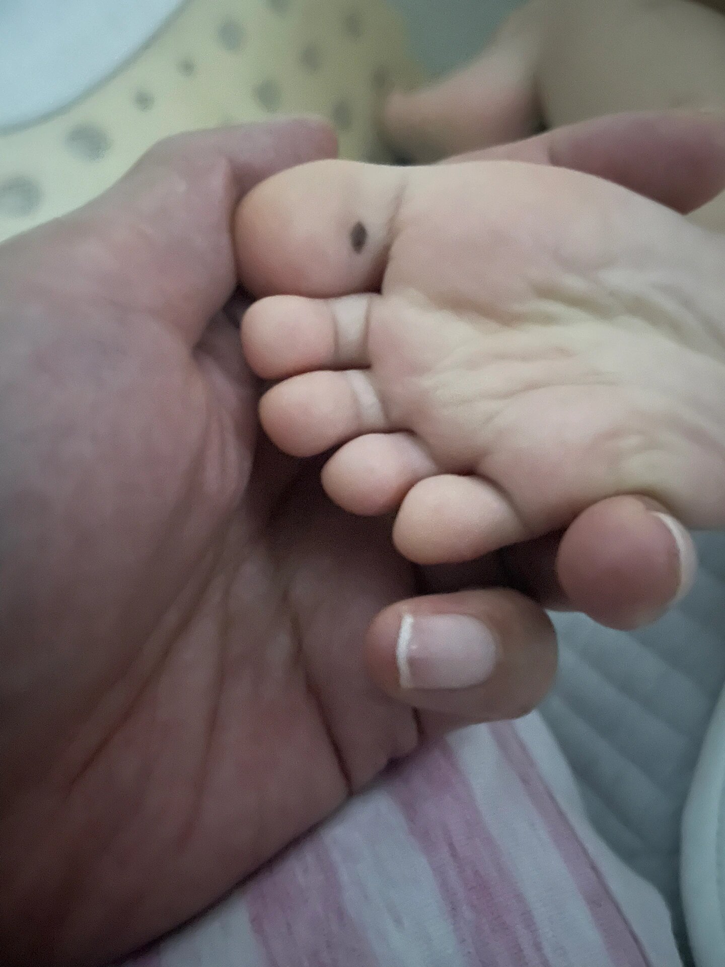 这种痣是不是要嘎掉.手术要麻醉吗?