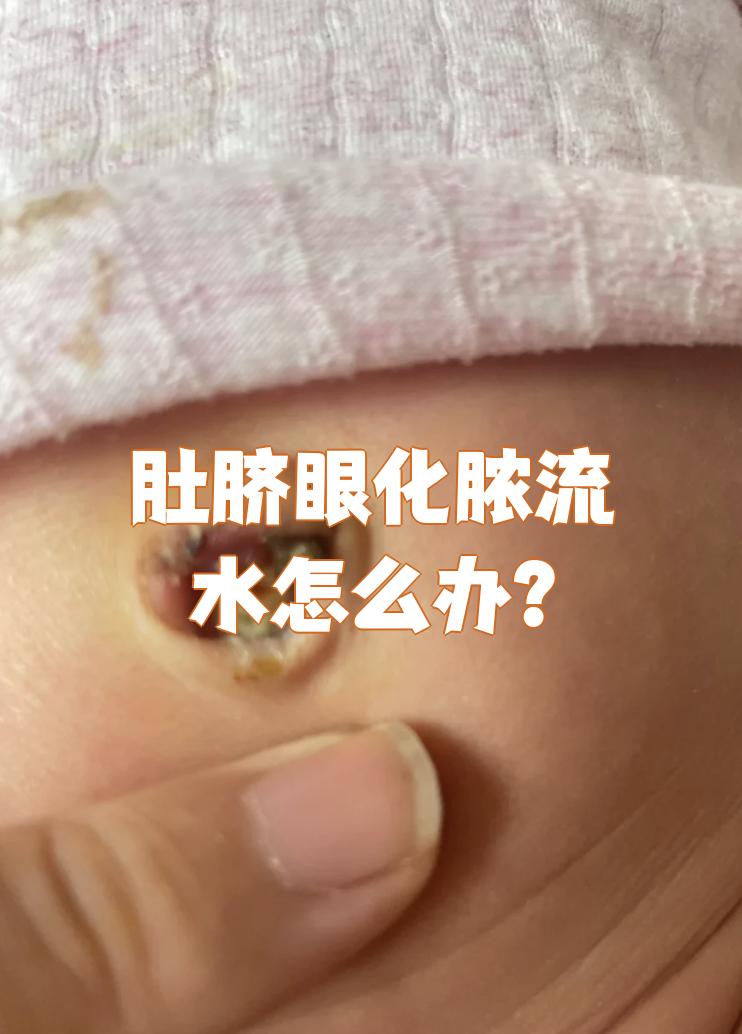 肚脐眼化脓流水怎么办?