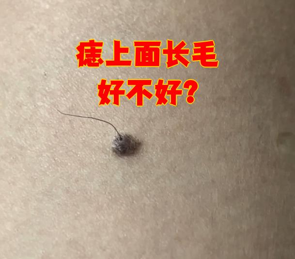 痣上面长毛好不好?
