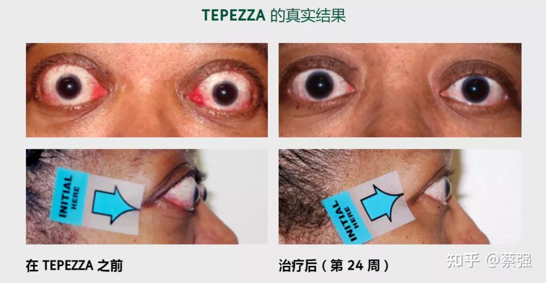 甲状腺眼病治疗里程碑突破性非手术疗法tepezza横空出世